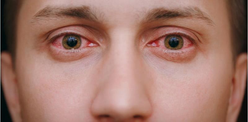 Bahaya Ke Kalau Urat Mata Jadi Merah? Puncanya Mungkin Sebab 5 Penyakit Ini!