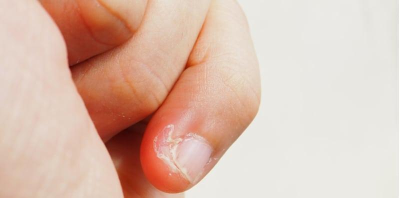 Jom Bongkar! Ini 9 Sebab Mengapa Kulit Jari Dekat Kuku Mengelupas