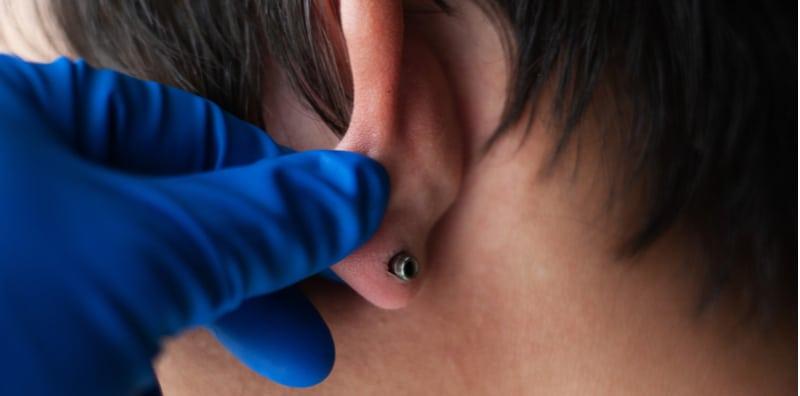 Cuping Telinga Anda Bengkak, Merah & Sakit? Ia Mungkin Bukan Sekadar Jerawat!