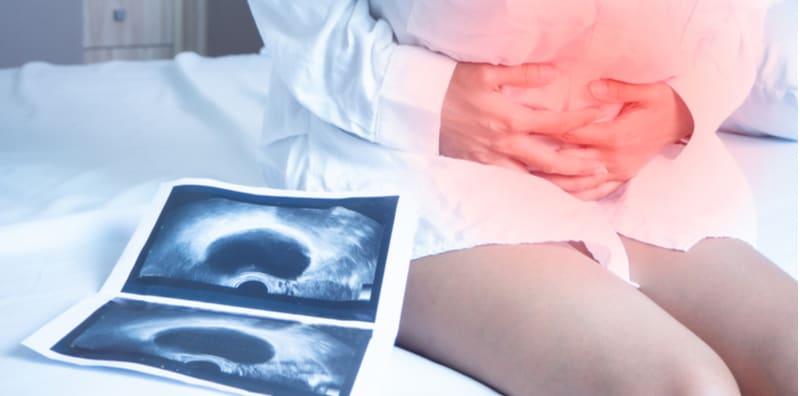 Rawatan Untuk Fibroid Rahim Terbahagi 2, Jom Kenal Dengan Lebih Lanjut!