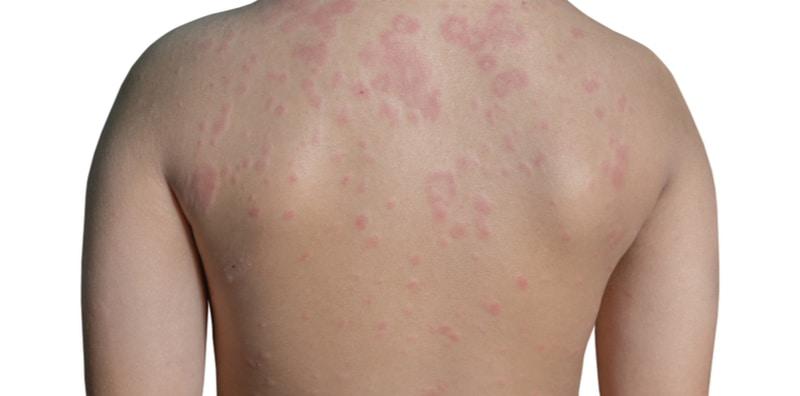 Kulit Gatal Angkara Gegata (Urtikaria), Ini Rupanya 7 Penyebab Ia Berlaku!