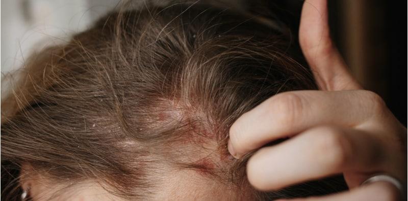 Kelemumur Punca Masalah Rambut Anda Gugur Sehelai Sehari? Ini Jawapannya!