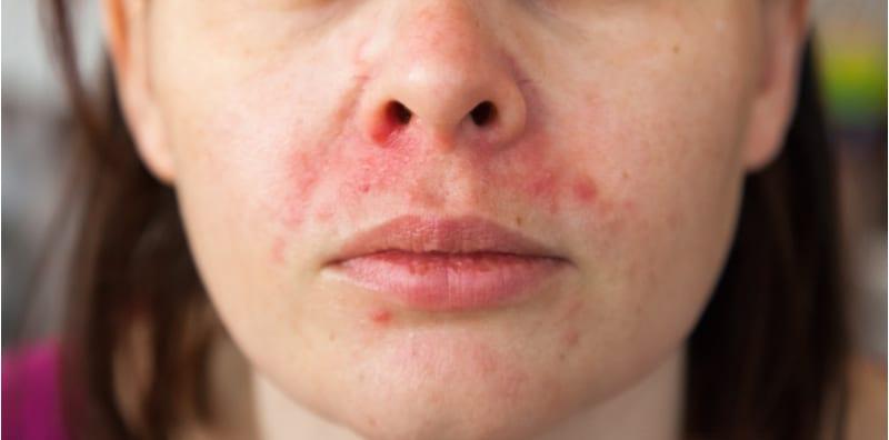 Kulit Menggerutu & Bersisik Akibat Dermatitis Perioral, Apakah Puncanya?
