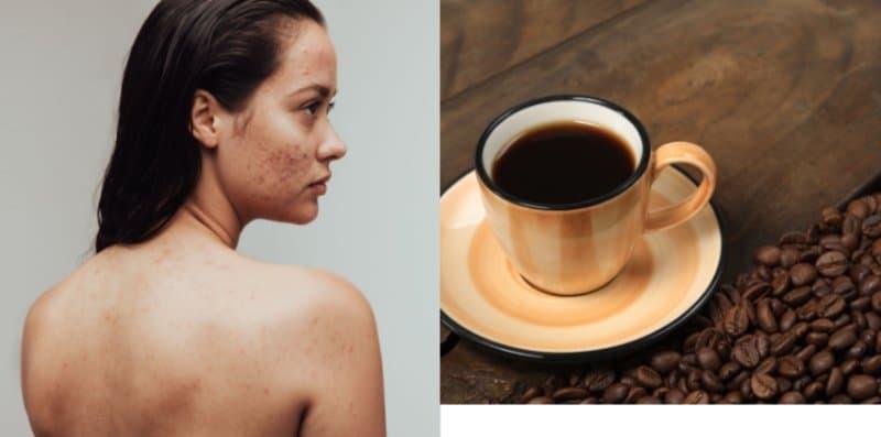 Anda Hantu Kopi? Jangan Minum Banyak Sangat, Itu Mungkin Punca Jerawat Tumbuh Melata!