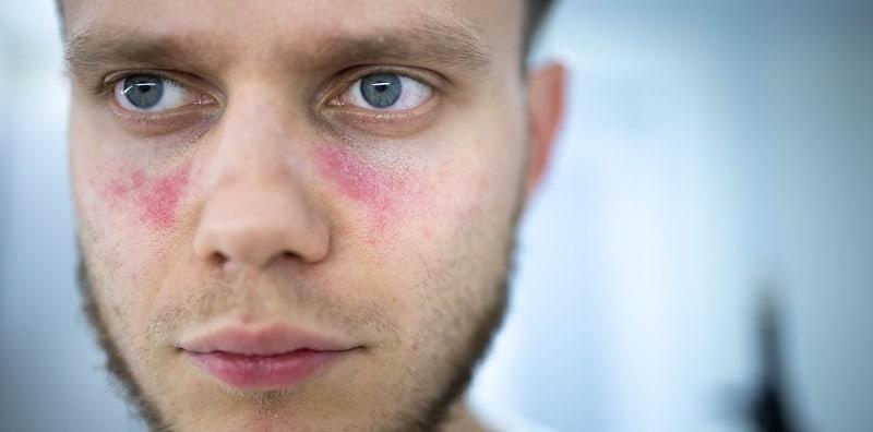 Ingat Lupus Hanya Serang Wanita? Lelaki Pun Boleh Kena, Ambil Tahu Risikonya!