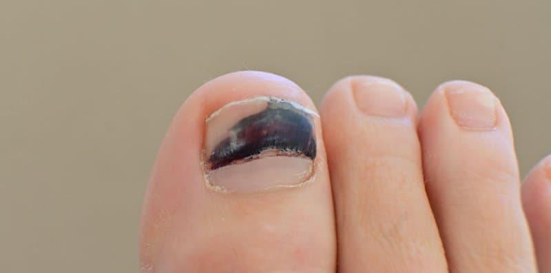 Kuku Kaki Hitam Gara-gara Aktif Bersukan? Ini Kaedah Keringkan Darah Beku Di Bawah Kuku!