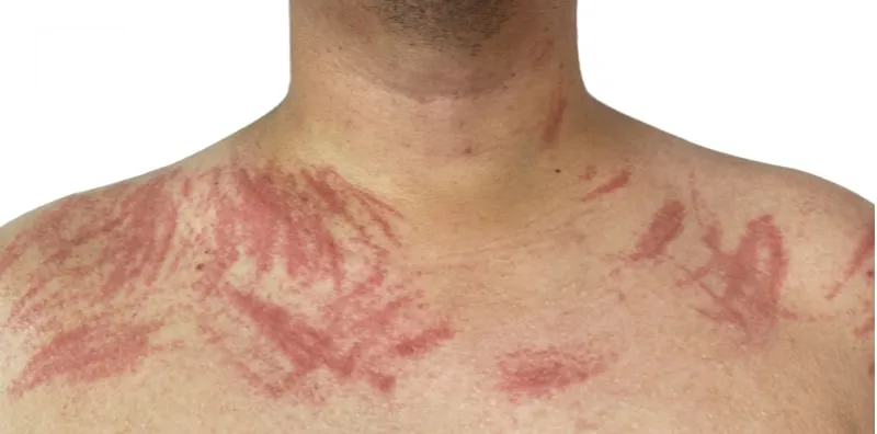 Kenali Dermatographia, Penyakit Kulit Yang Alah Dengan Sentuhan & Tekanan