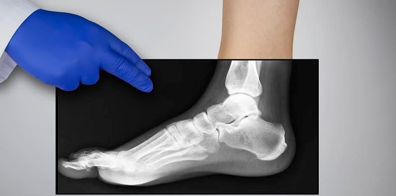 Pesakit Osteoporosis BERISIKO Alami Tulang Patah Masa Buat Kerja Rumah, Ini 13 Cara Nak Elak!