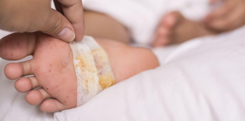 Pesakit Diabetes Biasanya Takut Kalau Ada Luka Bernanah, Ini 8 Petua Untuk Merawatnya