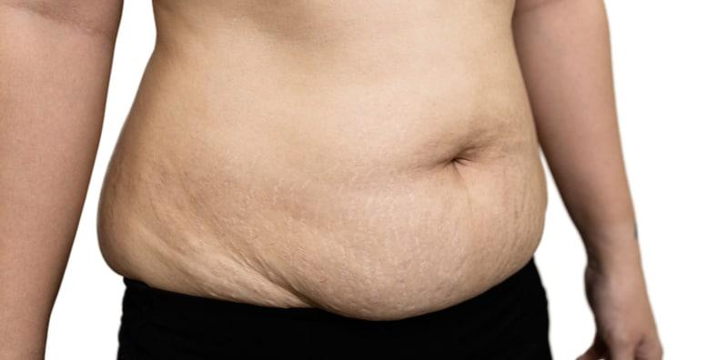 Segan Perut Menggeleber Lepas Bersalin? Mommies, Boleh Cuba Kaedah Ini, BERKESAN!