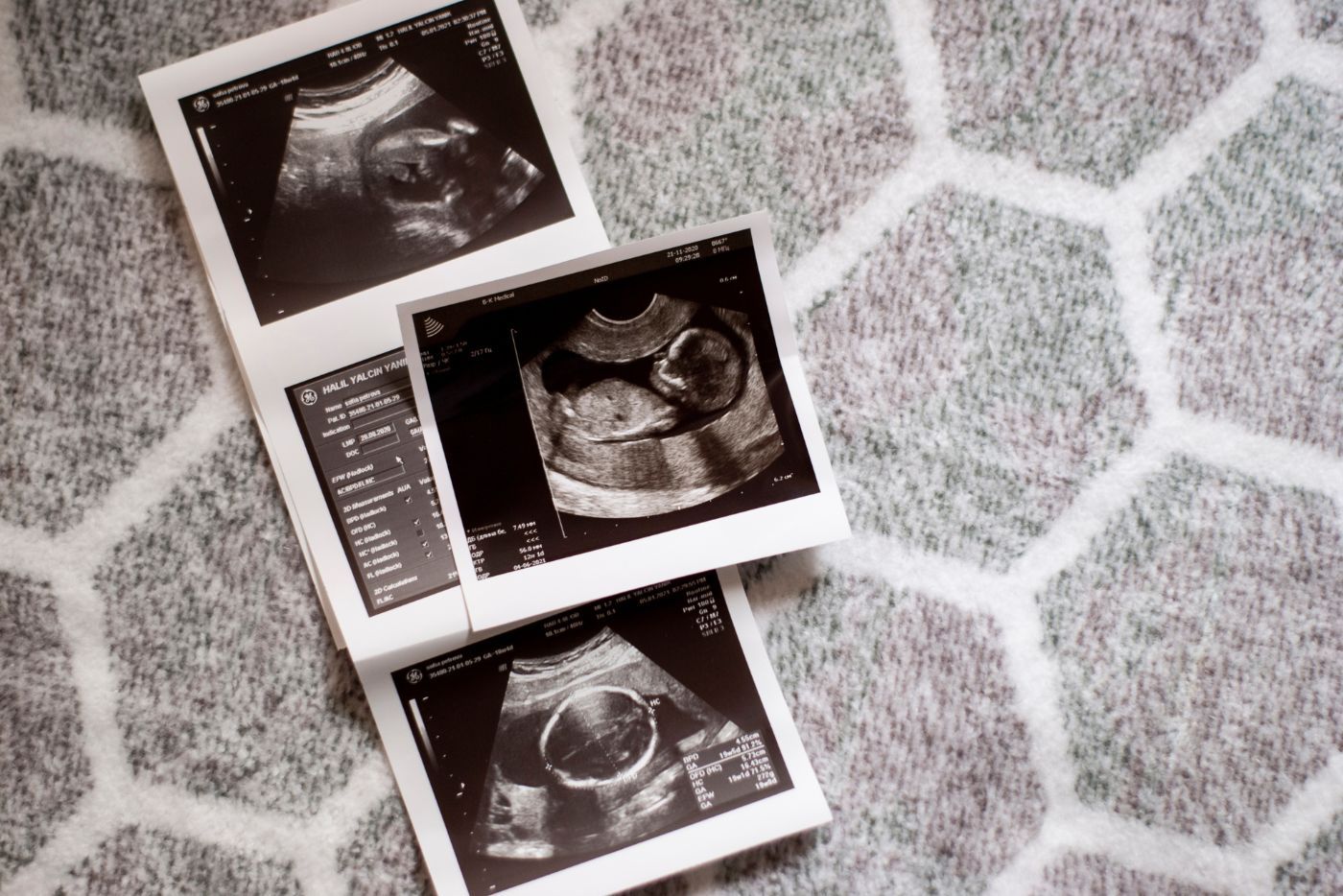 Dari Minggu 13 Hingga Minggu 27 Kehamilan, Ini Yang Akan Berlaku Pada Janin!