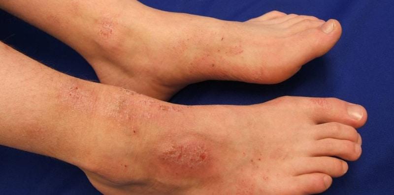 Masalah Kulit Kaki Merekah, Bengkak & Gatal, Ini Angkara Penyakit Ekzema Kaki!