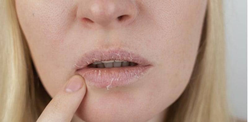 Bibir Kering, Berkerak & Berkuping Lepas Pakai Gincu Baru? Itu Tanda Dermatitis!