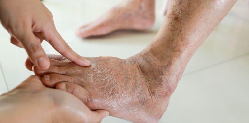 Orang Sakit Diabetes Bukan Saja Kena Potong Kaki, Tapi Ada Masalah Kaki Lain Yang Lebih Kronik!