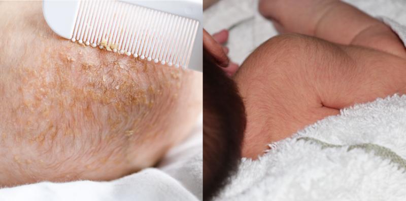 Ibu Ayah, Jangan Pelik Kalau Bayi 'Newborn' Anda Mengalami 8 Tanda Ini, Tak Bahaya!