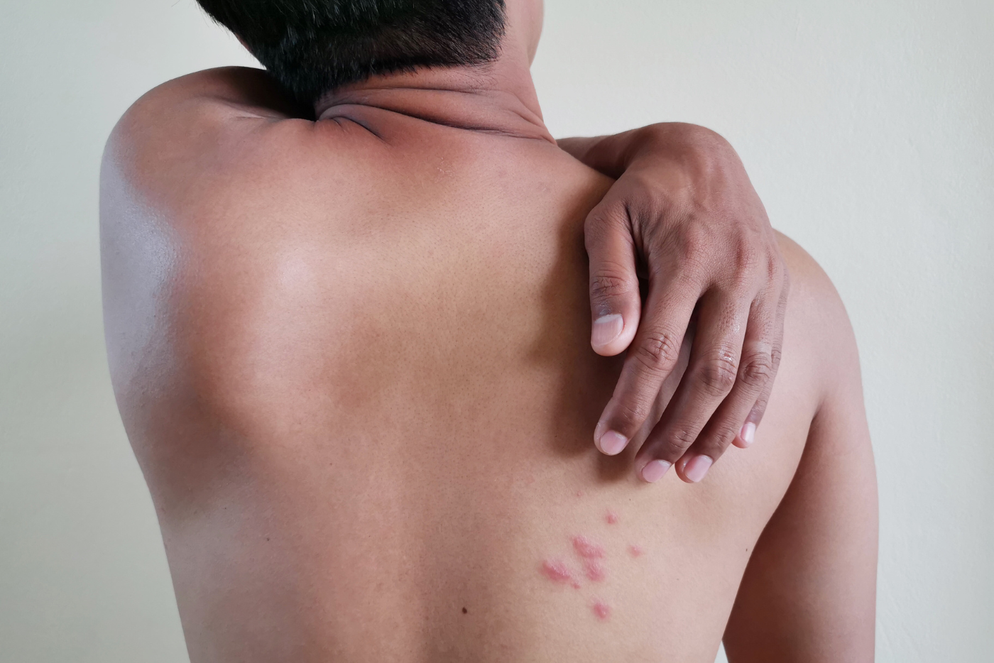 Ruam Tiba-tiba Tumbuh Di Badan? AWAS! Itu Mungkin Petanda Jangkitan HIV