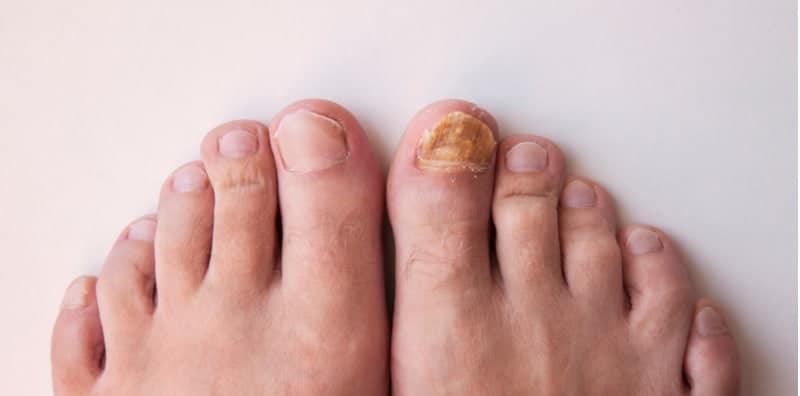 Penjagaan Kuku Yang Salah Membawa Risiko Pada Pesakit Diabetes, Elak Kesan Buruk Ini Dari Berlaku!