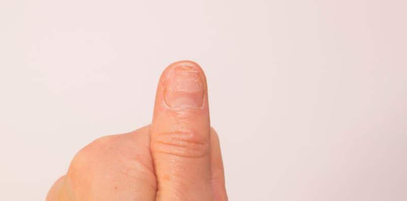 Jangkitan Kulat Kuku Yang Tidak Dirawat Boleh Berulang, Jangan Ingat Kuku Rosak Itu Perkara Biasa Saja!