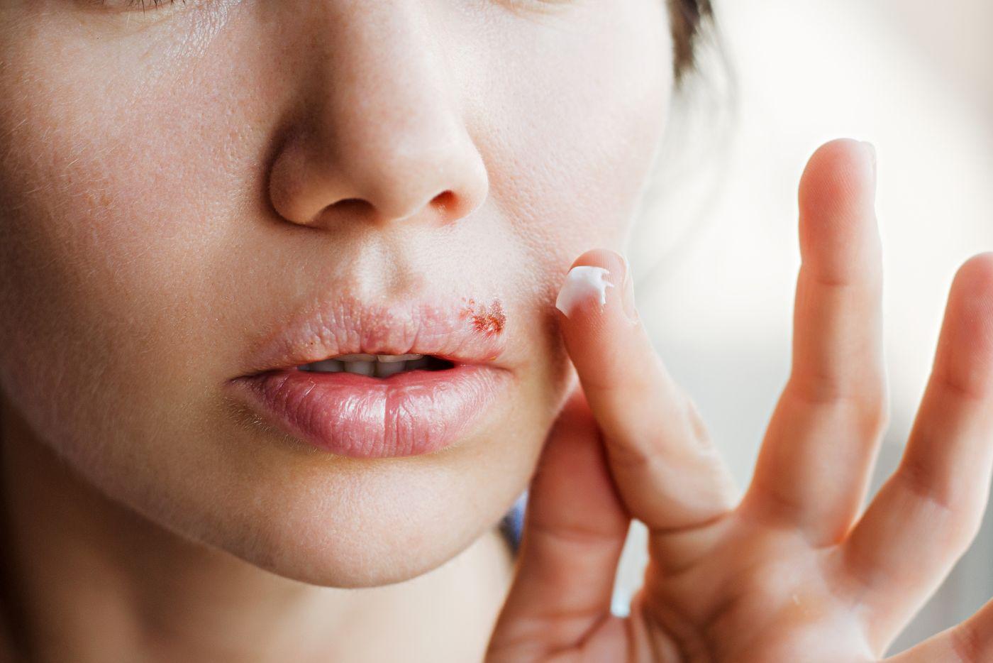 Anda Diserang Jangkitan Herpes? Cuba Remedi Natural Ini, Dapat Bantu Kawal Gejala!