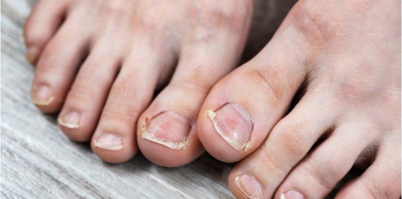 Lelaki Dan 3 Individu Ini Lebih Berisiko Menghidap Jangkitan Kulat Kuku, Patutlah Kuku Nampak Kekuningan!