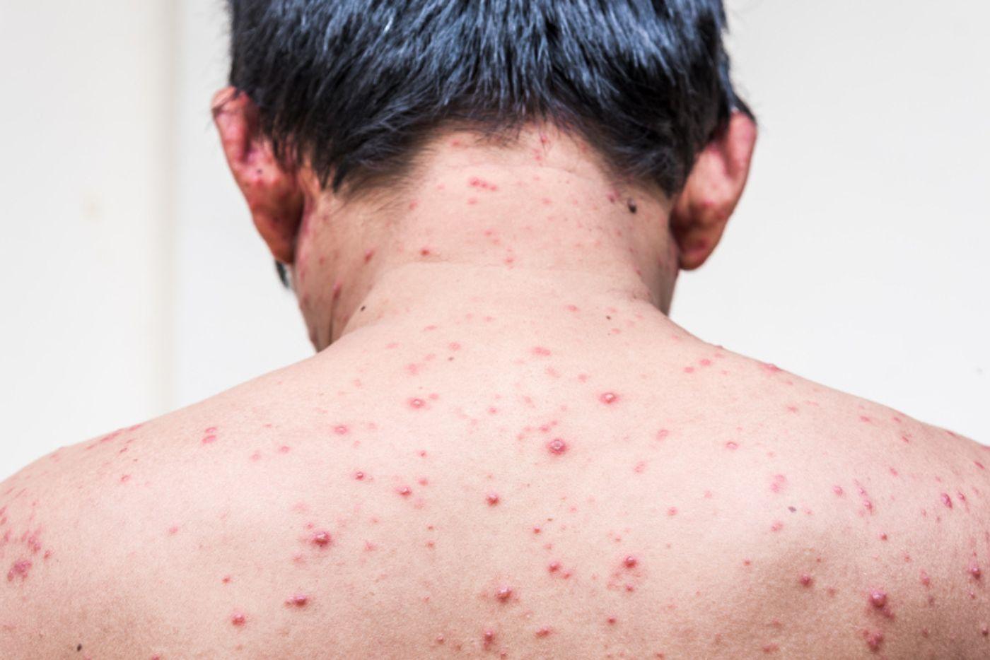 tanda-hiv-pada-kulit