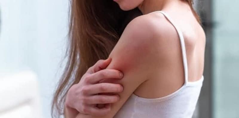 4 Tip Penting Untuk Rawat & Cegah Dermatitis Atopik (Salah Satu Jenis Ekzema!)