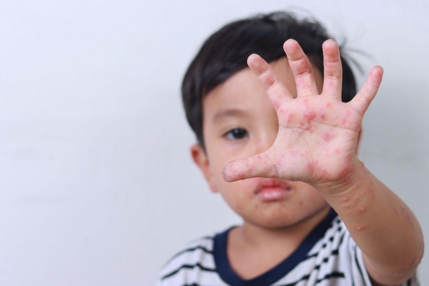 Jangan Biarkan Jika Anak Demam Campak! Parents Sila Ambil Tahu, Boleh Berjangkit!