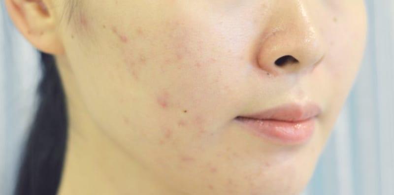 Papula VS Pustula: Jom Tahu Bagaimana Cara Untuk Bezakan 2 Jenis Jerawat Ini!