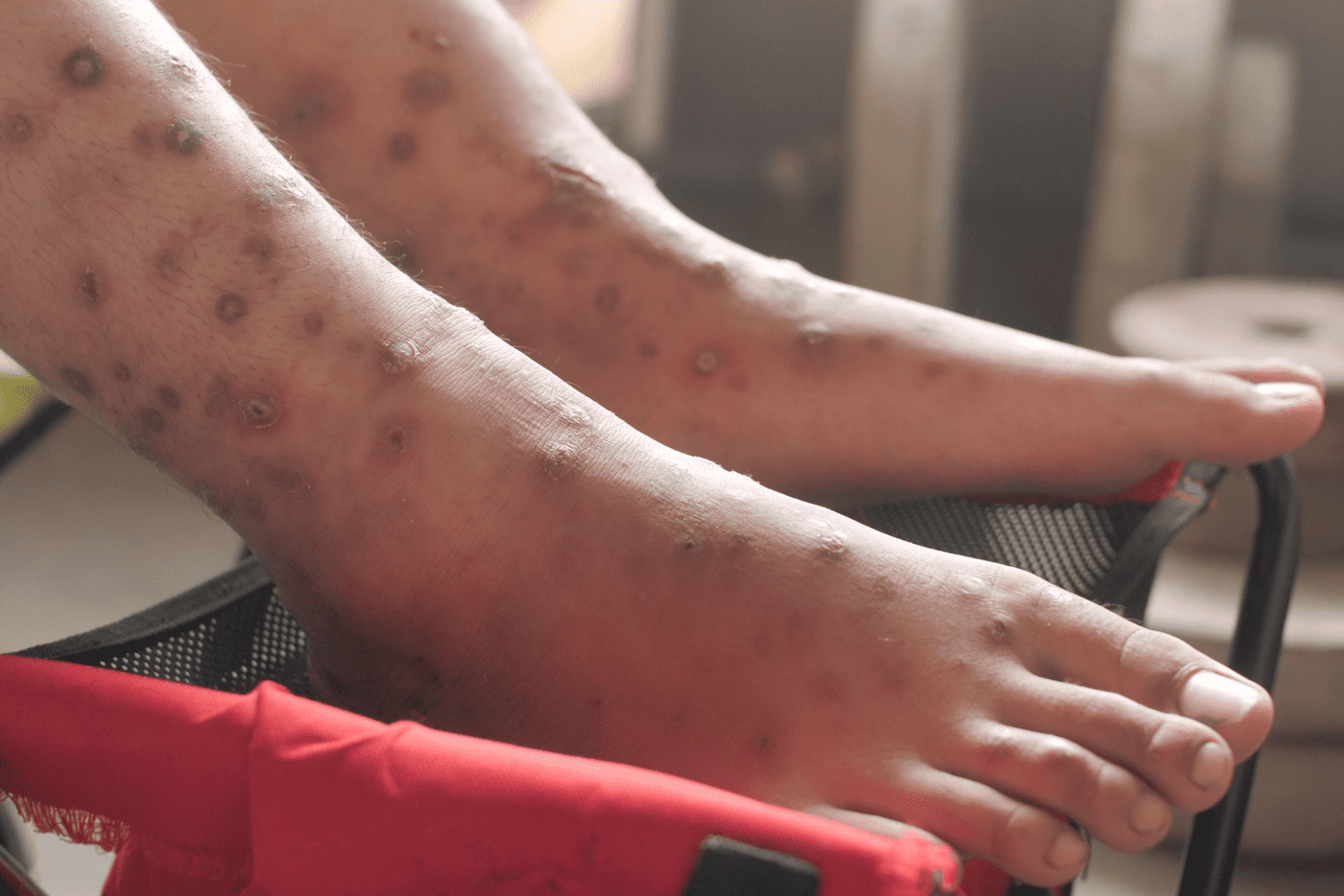 Tak Sangka! 5 Petua Semula Jadi Ini Mampu Rawat Kudis Buta Dengan Berkesan