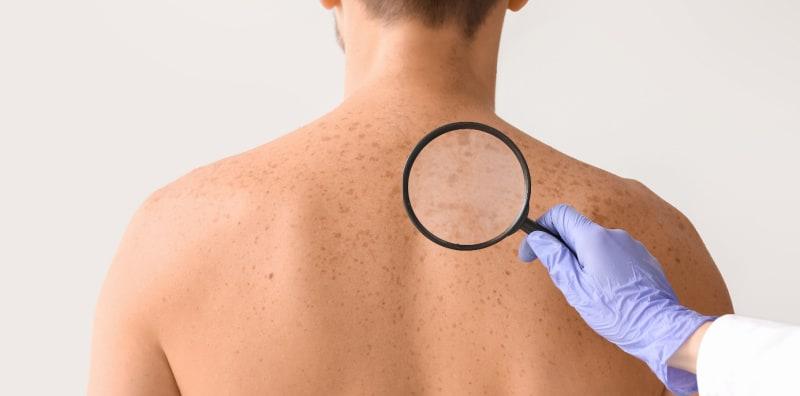 Bukan Semua Tanda Kanser Kulit Sama! Kenali Gejala Untuk 5 Jenis Ini!