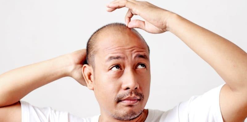 Stres Boleh Jadi Punca Banyak Masalah, Termasuk Rambut Gugur Dan Botak?