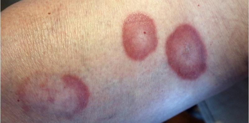 Awas! Pesakit Diabetes Boleh Alami Gangguan Pada Kulit, Annular Granuloma