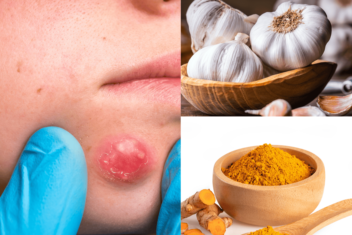 Ada Bisul Pada Kulit? Selain Antibiotik, 5 Petua Tradisional Ini Boleh Dicuba