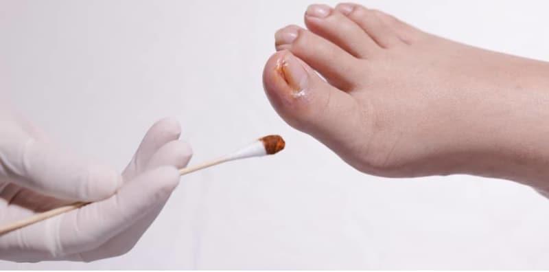 Ini 5 Masalah Kuku Kaki Yang Biasa Terjadi, Cagu Antara Yang 'Popular'!