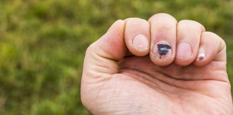 Darah Beku Pada Kuku Biru Bukan Akibat Tersepit Objek Berat Sahaja, Ada 7 Punca!