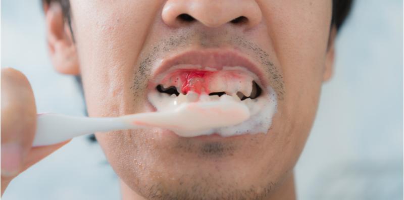 Gusi Mudah Berdarah? Ini Tanda Anda Kurang Vitamin! Semak 4 Gejala Lain