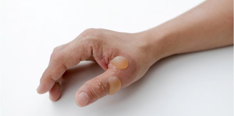 Gelembung Air Pada Jari Tangan? 9 Keadaan Ini Antara PUNCANYA