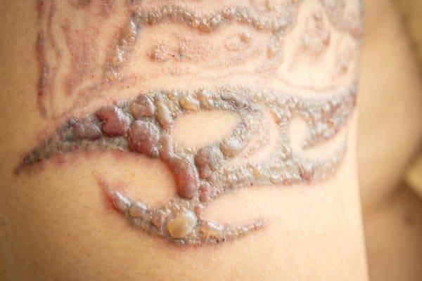 cara buang tattoo