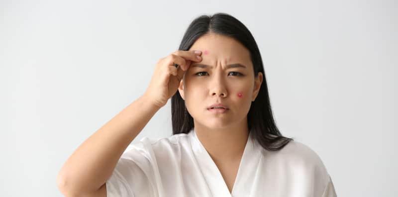 Parut Jerawat Hilang Dalam Masa 1 Hari? Ikut 8 Tip Ini, Cuma Guna Bahan Di Dapur Saja!