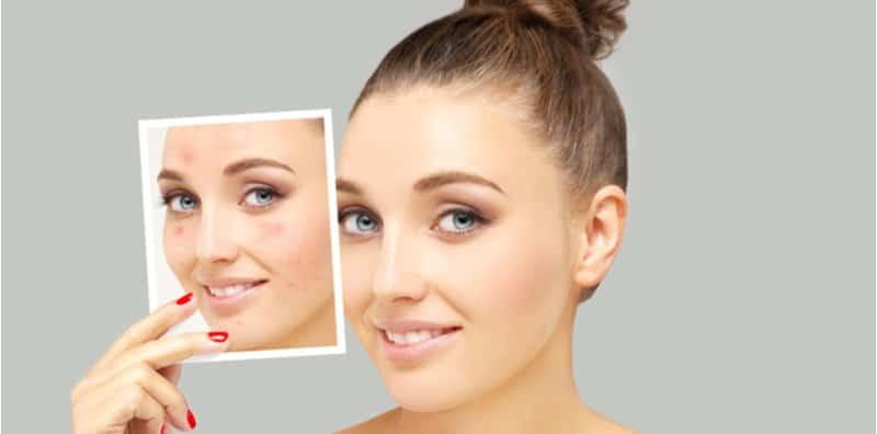 Nak Hilangkan Parut Jerawat? Pastikan Serum Anda Ada Bahan Ini, Barulah Licin Muka!