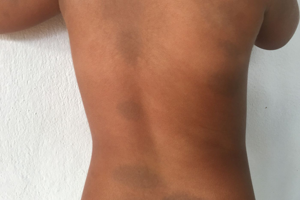 tanda lahir pada bayi