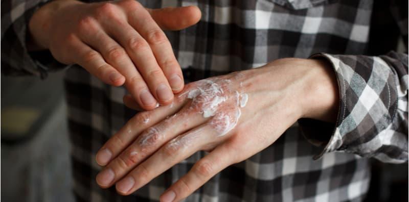 Nak Beli Ubat Ekzema Di Farmasi? Ini 6 Tip Dan Cara Rawatannya!