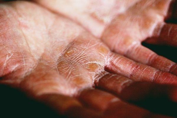 sabun mandi untuk psoriasis