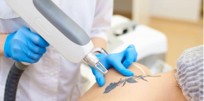 Buang Tatoo Dengan Laser, Ini Risiko Boleh Terjadi Terhadap Kulit & Kesihatan!