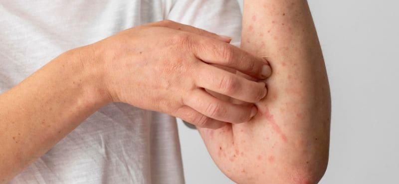 Gatalnya Badan... Ikut 6 Tip Mandi Dengan Betul Ini Agar Ekzema Tak Melarat!