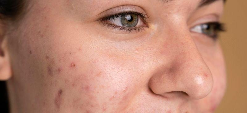 5 Punca Jerawat Naik Mendadak Ketika Remaja, Penyebab No. 4 Paling Lazim!