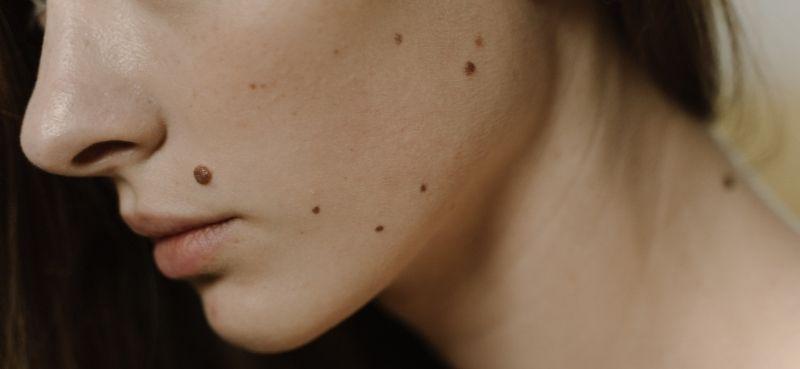 Ada Tompok Hitam Di Badan? Mungkin 5 Penyakit Ini Puncanya!