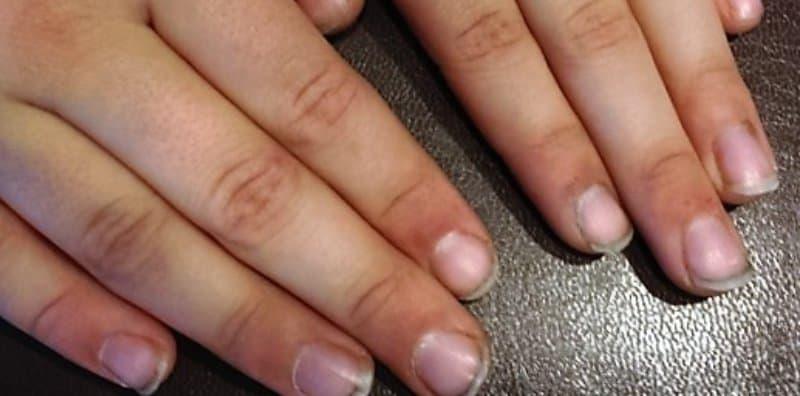 Gemar Biarkan Kuku Hitam Dan Berdaki? Awas! Anda Akan Dapat 4 Penyakit Ini!