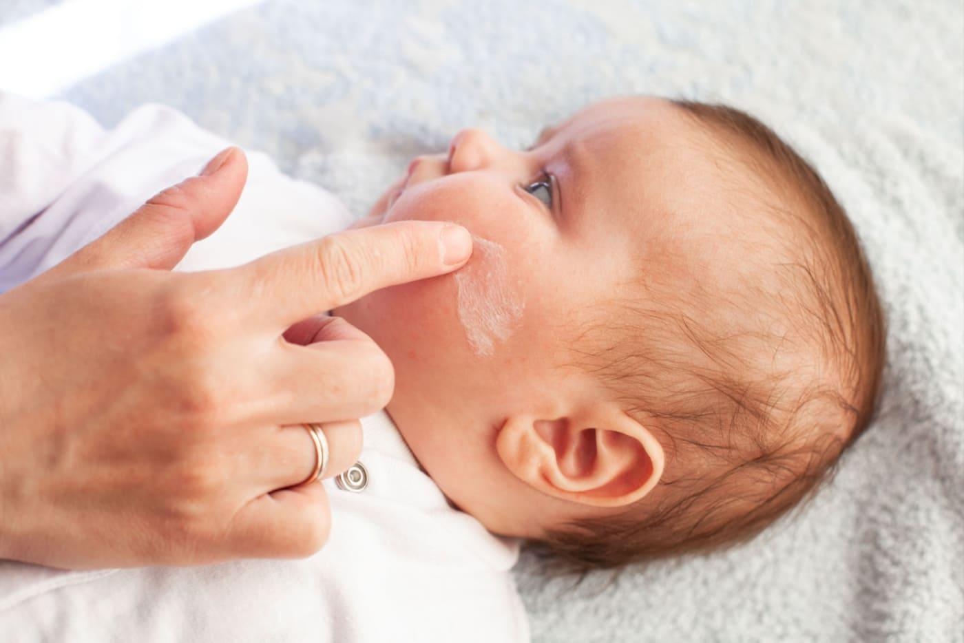 Kulit Baby Kering & Gatal? Ini 7 Produk Trending 2026 Untuk Ekzema Anak