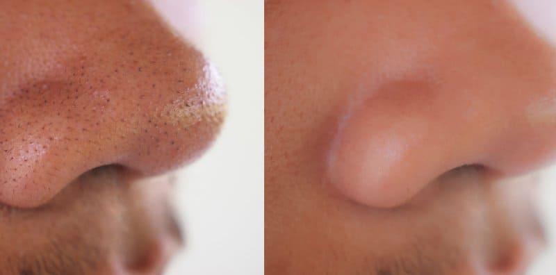 Jangan Picit Blackhead Di Hidung! 5 Cara Ini Lebih Berkesan Hilangkannya